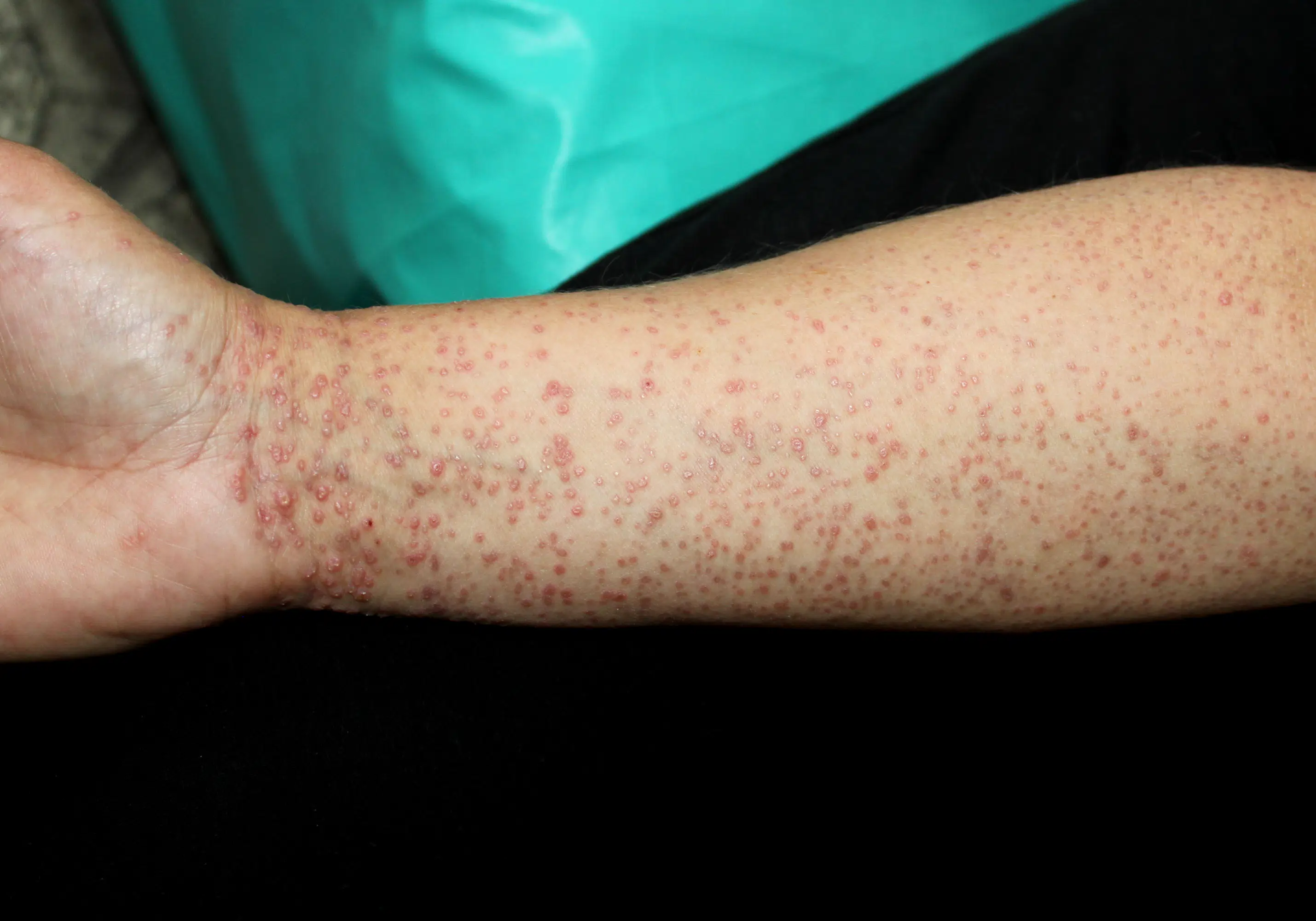 Lichen Planus